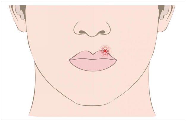 Cold Sore Outbreak? Here’s How To Stop It In Its Tracks - THE #1 SOURCE FOR ALTERNATIVE SOLUTIONS TO HEAL THY SELF!