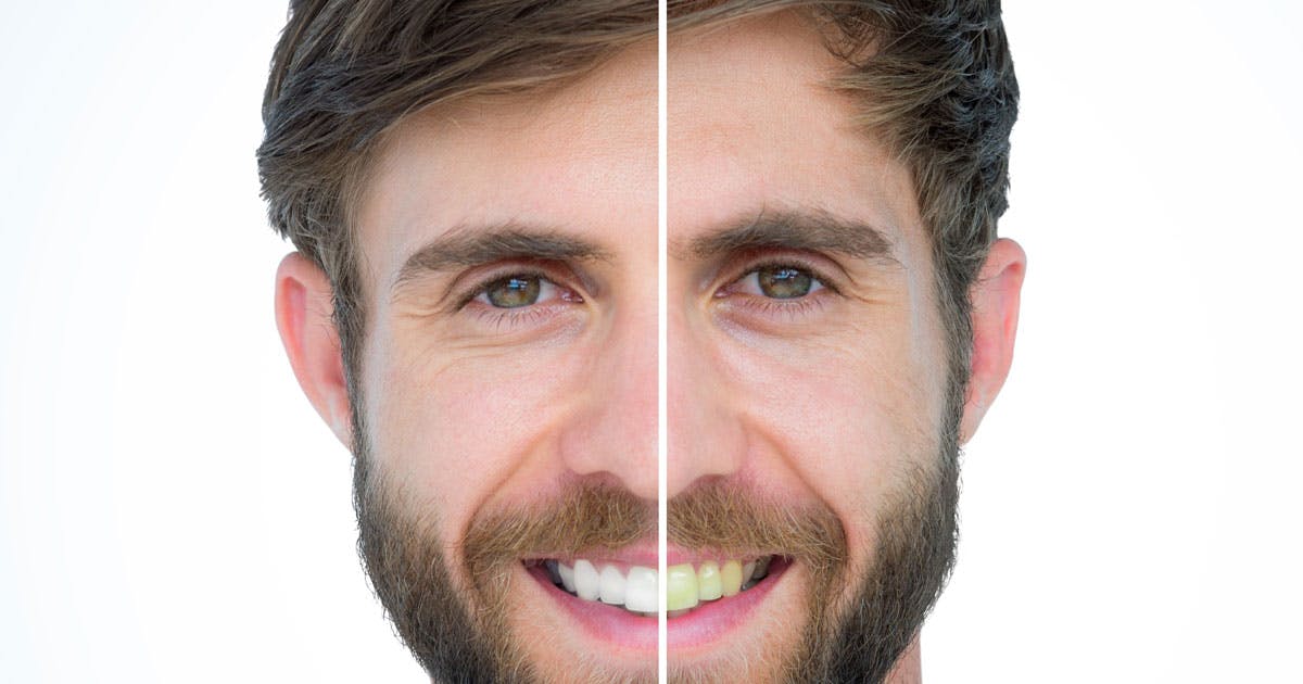 Signals that tell you to require Teeth Whitening Yagoona services