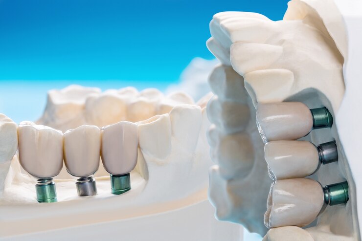 Dental Bridges Close Gaps in Your Teeth